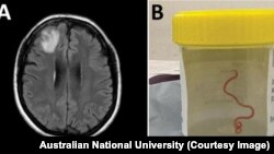 Crv od 8 centimetara, pronađen u mozgu jedne žene u Australiji 