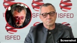 დემონსტრანტმა ზაზა ბიგიაშვილმა 2023 წლის მარტში თვალი და მხედველობა დაკარგა