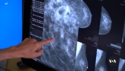 Does AI detect breast cancer better than doctors can?