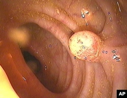 Ilustrasi - Tes kanker usus besar (Colon Cancer Test).
