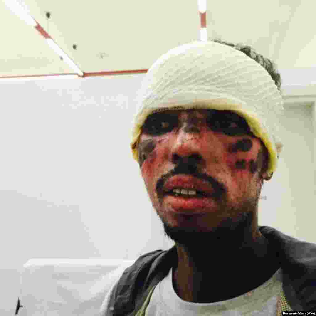 Un homme a eu son visage brûlé par les passeurs en tentant de rejoindre la Libye pour prendre un bateau pour l&#39;Europe. Cette image a été obtenue par VOA Afrique auprès d&#39;un médecin italien de Milan qui soigne les migrants dans un centre d&#39;accueil. &nbsp;