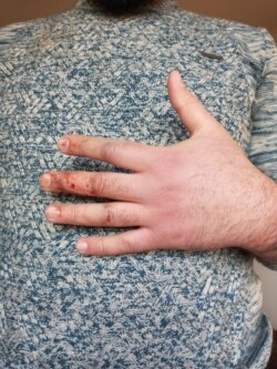 Bruises are seen on the hand of Syrian journalist Jindar Barakat, who was kidnapped and beaten Jan. 18, 2022. (Photo courtesy of Jindar Barakat)