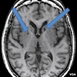 Hasil MRI atas otak pasien yang pernah terkena stroke dua kali. Panah menunjukkan adanya bintik-bintik gelap yang dulunya adalah sel-sel sehat yang mati akibat gumpalan darah yang masuk ke otak.