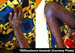 Cacar monyet merebak di Bakouma di bagian timur Afrika Tengah (courtesy: FB/Dieudonne Assanah)