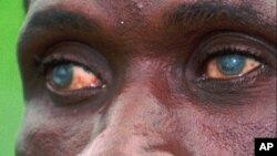 Penyakit kebutaan sungai yang disebabakan oleh cacing parasit paling sering terjadi di sub-Sahara Afrika. Dalam fase aktif penyakit itu, cacing betina memproduksi jutaan telur mikroskopis yang bermigrasi ke berbagai jaringan di seluruh tubuh. Infeksi pada mata bisa menyebabkan kebutaan (foto: Dok).